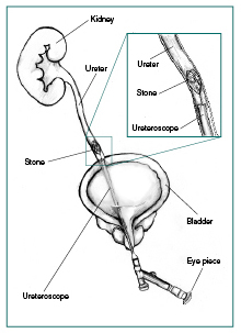 ureteroscopic