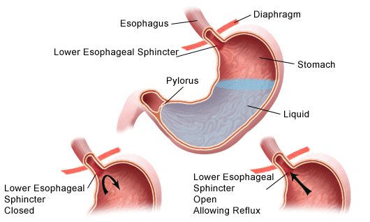 gerd-reflux-stomach-diagram