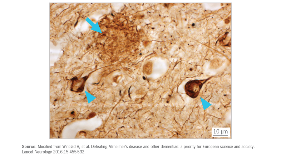 A zoomed-in view of the frontal cortex shows beta-amyloid plaques (arrows) and tangled strands of protein fibers (arrowheads).